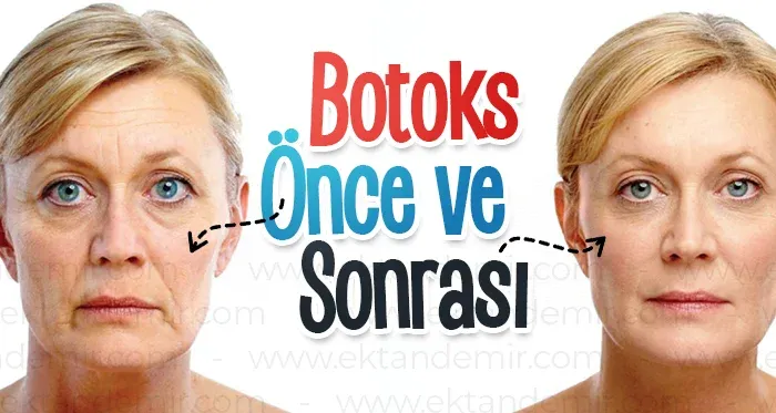 Botoks Sonrası Dikkat Edilmesi Gerekenler: Doğal Bir Görünüm İçin Tam Rehber
